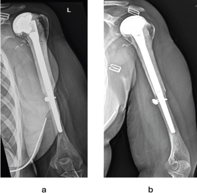 Figure 5: Post-reconstruction follow-up radiographs. Post-operative radiographs showing the allograft-prosthetic composite reconstruction. (a) Anteroposterior view demonstrating the pyrocarbon humeral head hemiarthroplasty with proximal humeral allograft, secured with cerclage wires and a long humeral stem. (b) Lateral view showing stable reconstruction with well-positioned components and maintained alignment.