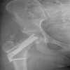 Failure of the Femoral Neck System in a Young Patient: A Case Report