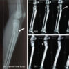 Proximal Tibial Giant Cell Tumor in a Skeletally Immature Child: A Diagnostic Dilemma and Review of the Literature