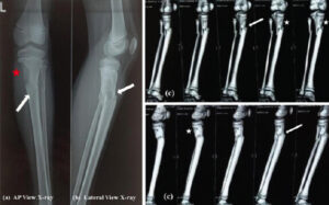 Figure 1: Plain anteroposterior (a) and lateral (b) radiographs of the left leg showing an eccentric osteolytic lesion involving the medial aspect of the proximal tibial metaphysis (red asterisk). An associated minimally displaced fracture involving the proximal tibia and fibula is seen (white arrow). (c) Non-contrast computed tomography scan of the left leg demonstrating an ill-defined, lobulated, expansile lytic lesion in the metadiaphyseal region of the medial proximal tibia with thin, sclerotic cortical margins (white asterisk). A fracture line is seen extending through the lesion (white arrow). Both the tibial and femoral epiphyses are open, and there is no invasion of the tibial epiphysis by the lesion.