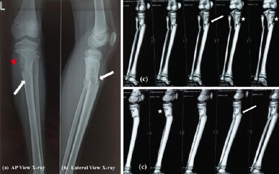 Figure 1: Plain anteroposterior (a) and lateral (b) radiographs of the left leg showing an eccentric osteolytic lesion involving the medial aspect of the proximal tibial metaphysis (red asterisk). An associated minimally displaced fracture involving the proximal tibia and fibula is seen (white arrow). (c) Non-contrast computed tomography scan of the left leg demonstrating an ill-defined, lobulated, expansile lytic lesion in the metadiaphyseal region of the medial proximal tibia with thin, sclerotic cortical margins (white asterisk). A fracture line is seen extending through the lesion (white arrow). Both the tibial and femoral epiphyses are open, and there is no invasion of the tibial epiphysis by the lesion.