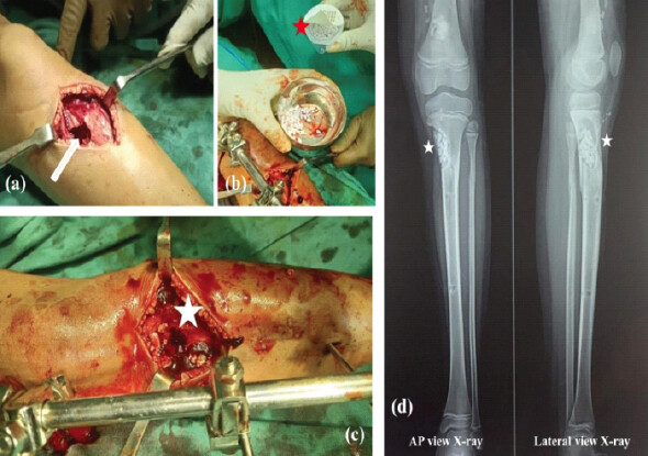 Figure 2: Intraoperative photographs showing: (a) A cortical window for intralesional curettage (white arrow). (b) chronOS granules (synthetic β-tricalcium phosphate) (red asterisk). (c) The cavity filled with autologous cancellous bone graft and chronOS granules, with stabilization of the fracture using an external fixator. (d) Follow-up AP and lateral radiographs of the left leg at three months demonstrating the cavity filled with chronOS granules (white asterisk).