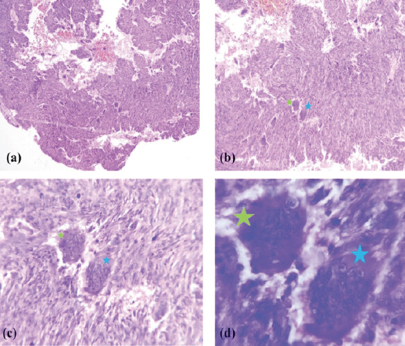 Figure 3: Photomicrographs of hematoxylin-eosin-stained sections (a, b, c, and d at ×4, ×10, ×40, and ×100 magnification, respectively) showing classical histologic features of giant cell tumor of bone, with uniformly distributed osteoclast-like multinucleated giant cells in a background of round-to-oval and spindle-shaped mononuclear stromal cells. No anaplasia, necrosis, or increased mitotic activity is identified. (c) and (d) Osteoclast-like multinucleated giant cells (green and blue asterisk) at ×40 and ×100 magnification.