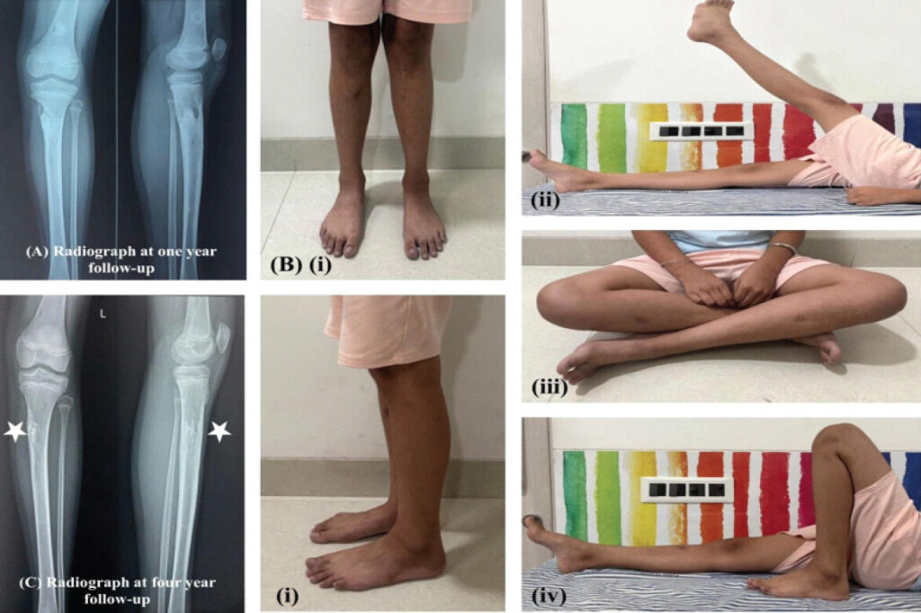 Figure 4: (a) One-year follow-up radiographs demonstrating progressive graft incorporation and lesion healing. (b) Clinical photographs at 4-year follow-up showing (i) standing, (ii) active leg raise, (iii) cross-leg sitting, (iv) Full knee flexion. (c) Anteroposterior and lateral radiographs of the left leg at 4-year followup showing complete healing of the lesion with graft incorporation (white asterisk) and excellent remodeling.