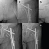 Intrapelvic Neck Screw Migration after Trochanteric Fixation Nail Advanced Fixation of a Trochanteric Femoral Fracture: A Case Report and Proposed Treatment Algorithm