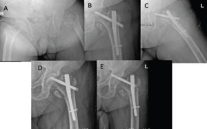Figure 1: Radiological images of the hip. (a) Trochanteric fracture. (b) Post-operative anteroposterior (AP) view. (c) Post-operative axial view. (d) AP view 10 days after the surgery. (e) AP view 5 weeks after the surgery.