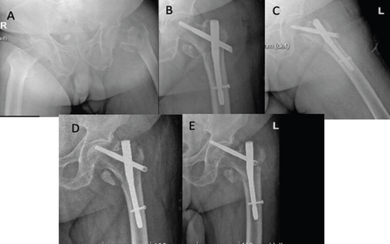 Figure 1: Radiological images of the hip. (a) Trochanteric fracture. (b) Post-operative anteroposterior (AP) view. (c) Post-operative axial view. (d) AP view 10 days after the surgery. (e) AP view 5 weeks after the surgery.