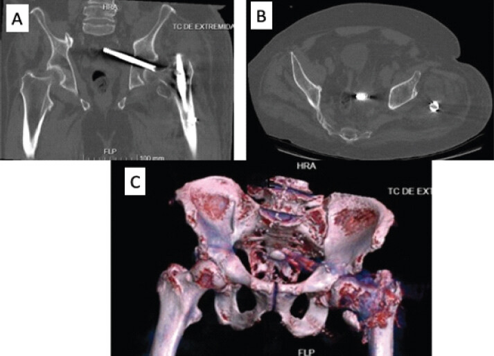 Figure 2: Computed tomography scan images. (a) Coronal view. (b) Axial view. (c) 3D reconstruction.