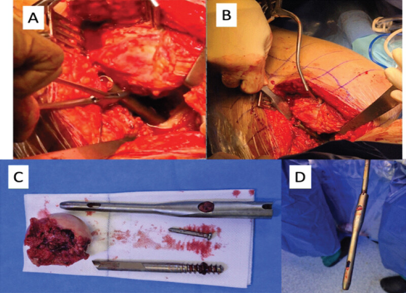 Figure 3: Intraoperative images. (a and b) Removal of the lag screw. (c) Femoral head and implants after removal. (d) Image of the nail after extraction with the aid of the lag screw.
