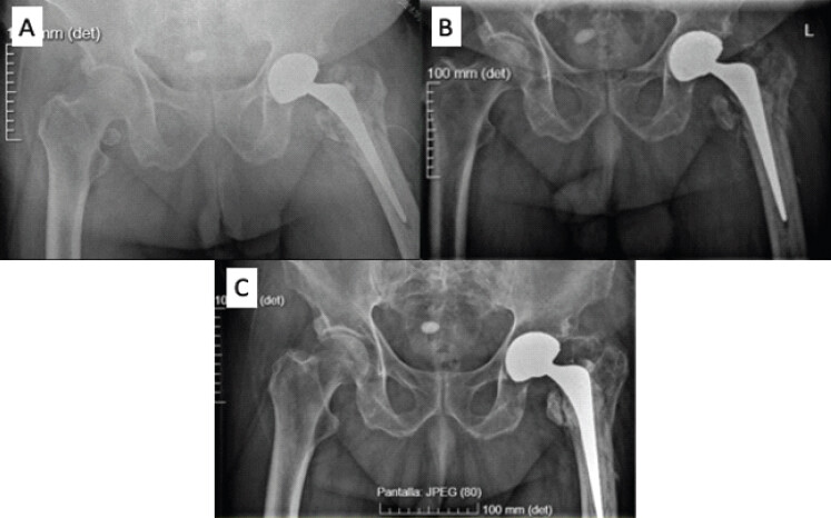 Figure 4: Radiological images. (a) Immediate post-operative. (b) 1 month after surgery. (c) 16 months after surgery.