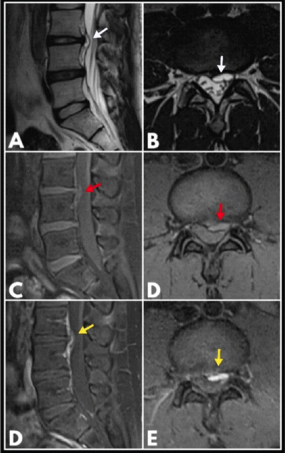 Figure 2: T2-weighted magnetic resonance imaging (MRI) sequences (a and b) demonstrating a hyperintense left paracentral discal cystic lesion at the L3–L4 level (White arrows). T1-weighted MRI sequences (c and d) (red arrows). Post-contrast images demonstrating gadolinium enhancement with septations within the cyst (e and f) (Yellow arrows).