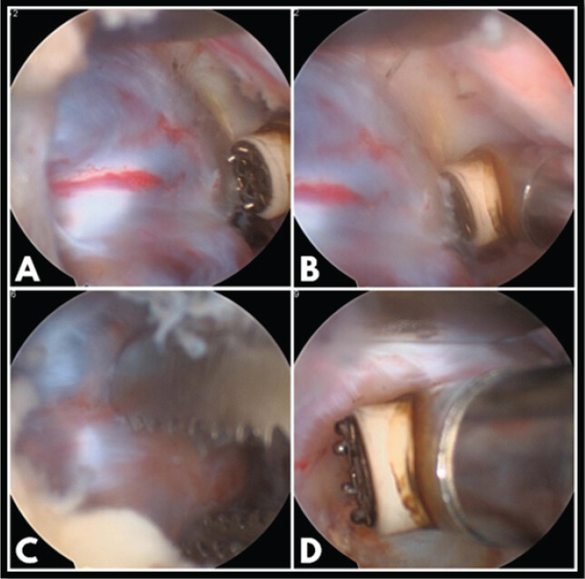 Figure 3: Identification of the discal cyst as a glistening, globular structure with blood vessels in its wall; neural elements are seen stretched and compressed over the cyst (a). Circumferential dissection of the cyst performed using a radiofrequency probe (b). Biopsy specimen obtained with pituitary forceps (c). Cyst debulking followed by ablation of residual tissue (d).