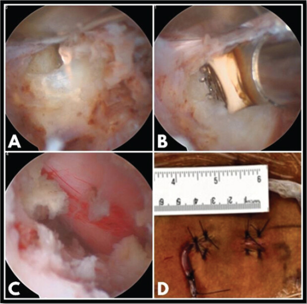 Figure 4: Identification of an annular rent ventral to the cyst location (a). Annuloplasty performed using the radiofrequency probe (b). Adequate decompression achieved with freely mobile neural structures (c). Wound closure performed over a drain (d).
