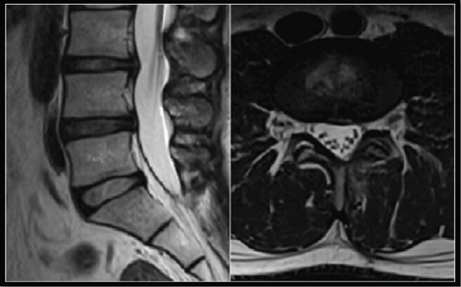 Figure 5: Follow-up magnetic resonance imaging at 6 months demonstrating no evidence of recurrence with preservation of the posterior soft-tissue structures.