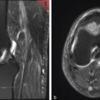 Figure 1: Magnetic resonance imaging (MRI) of subpatellar nodular fasciitis with patellar erosion. (a) Sagittal T2-weighted MRI of the right knee demonstrating a multilobulated, hyperintense intra-articular mass arising from the subpatellar region with erosion of the inferior cortical surface of the patella. (b) Axial T2-weighted MRI of the right knee showing a heterogeneous hyperintense subpatellar soft-tissue mass with associated cortical erosion of the undersurface of the patella.