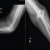 Staged Bilateral Total Elbow Arthroplasty in Advanced Rheumatoid Elbow Disease: A Case Report