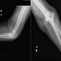 Figure 1: Pre-operative anteroposterior and lateral radiographs of the right elbow, showing advanced rheumatoid joint destruction with reducible dislocation.