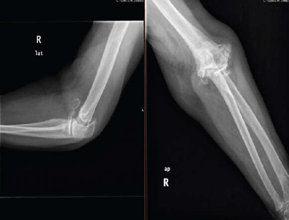 Figure 1: Pre-operative anteroposterior and lateral radiographs of the right elbow, showing advanced rheumatoid joint destruction with reducible dislocation.