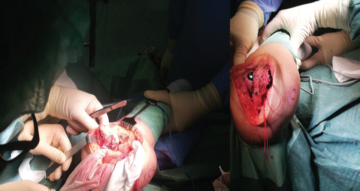 Figure 2: Intraoperative photographs of the right total elbow arthroplasty (December 2019), showing surgical exposure and the implant secured in place.