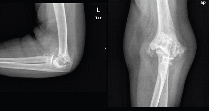 Figure 3: Radiographs of the left elbow at the time of staged surgery, showing progression of contralateral rheumatoid joint destruction.