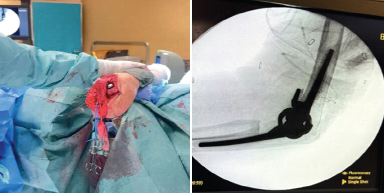 Figure 4: Intraoperative findings during left total elbow arthroplasty (October 2024): surgical wound closure and fluoroscopic confirmation of implant position.