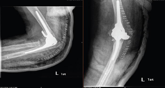 Figure 5: Post-operative radiographs of the left elbow, showing the total elbow arthroplasty construct in extension and flexion.