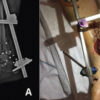 Soft-Tissue Closure through Acute Deformation and Gradual Correction Using Taylor Spatial Frame in a Gustilo-Anderson Type IIIB Open Tibial Pilon Fracture: A Case Report