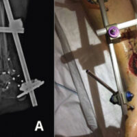 Figure 1: (a and b) Gustilo-Anderson Type IIIB open fracture of the distal tibial pilon. Left: initial clinical photograph showing the open wound. Right: anteroposterior radiograph demonstrating the fracture pattern.