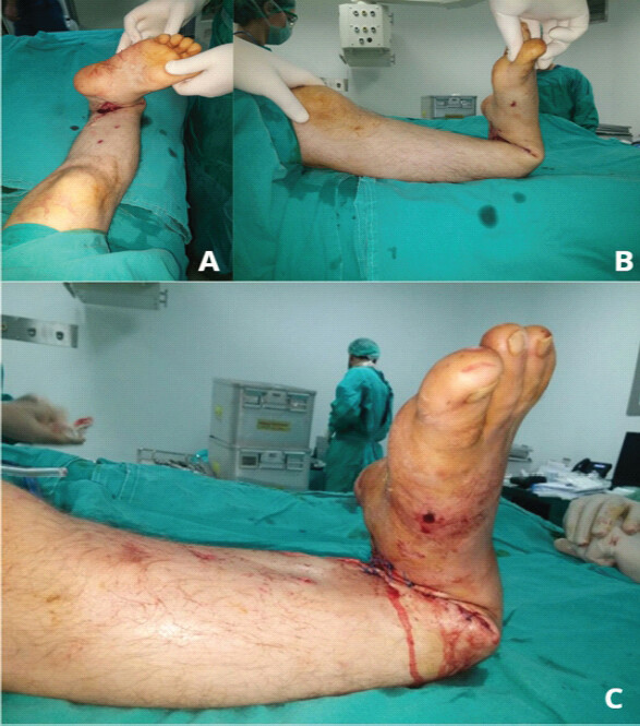 Figure 4: (a-c) Primary wound closure following 5 cm fibular resection and creation of 110° acute varus deformity. The wound margins are approximated without tension.