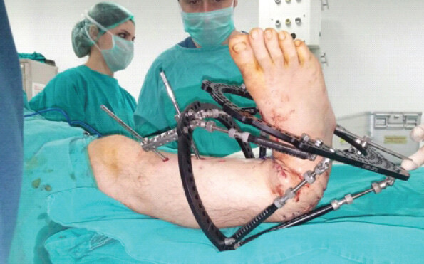 Figure 5: Taylor Spatial Frame applied with the limb secured in the deformed position.