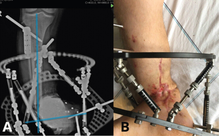 Figure 6: (a and b) Left: Early post-operative radiograph showing the 110° varus deformity. Right: Following gradual distraction with TSF, the foot has been restored to anatomical position.