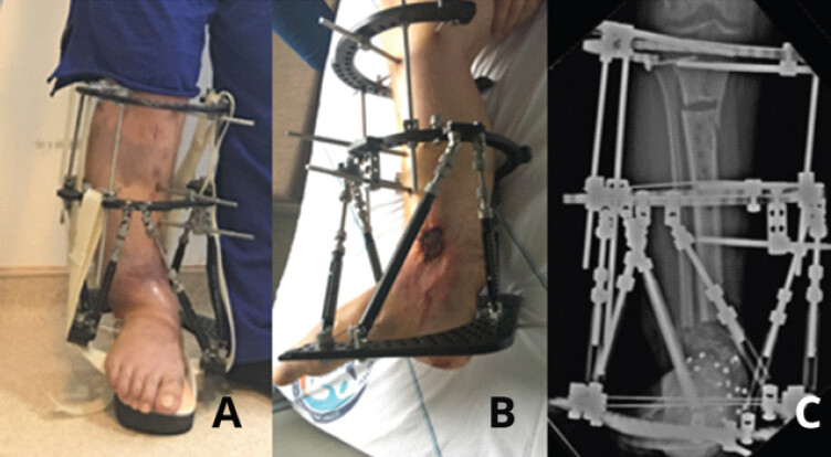 Figure 7: (a-c) Fixator revision and proximal tibial osteotomy for limb lengthening through distraction osteogenesis.