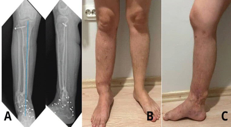 Figure 8: (a-c) Final radiographic and clinical appearance following treatment completion. Anatomical alignment has been restored and the wound is fully healed.