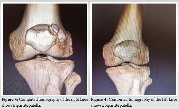Tripartite Patella: A Rare Case Report | Journal of Orthopaedic Case ...