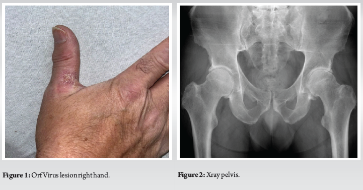 Orph Infection A Rare Case of Orf Virus Precipitating Methicillin-Resistant ...