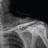 Shoulder without a Clavicle: Movement and Function after Total Claviclectomy: A Case Report