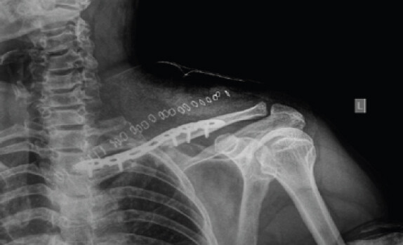 Figure 1: Post op x-ray following ORIF of the left clavicle.