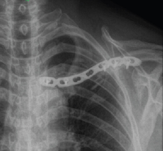 Figure 2: 2 month post-op x-ray showing osteomyelitis of the left clavicle with implant loosening, cortical destruction, and non-union.