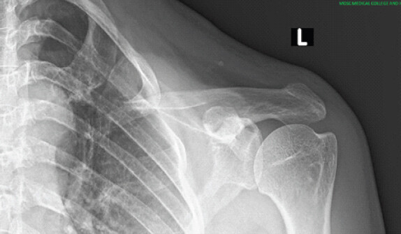 Figure 3: X-ray after total claviclectomy.