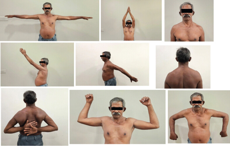 Figure 4: Range of movement of the left shoulder 2 years after total claviclectomy