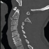 Blunt Traumatic Posterior Cord Syndrome Following a Hangman Fracture: A Case Report