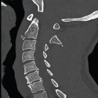 Figure 1: Sagittal computed tomography of the cervical spine demonstrating a right C1 transverse process fracture, a C2 hangman fracture with lamina, spinous process, and teardrop fracture components, and a C3 spinous process fracture without subluxation.