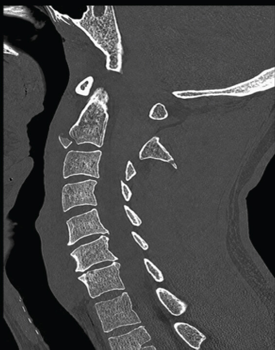 Figure 1: Sagittal computed tomography of the cervical spine demonstrating a right C1 transverse process fracture, a C2 hangman fracture with lamina, spinous process, and teardrop fracture components, and a C3 spinous process fracture without subluxation.