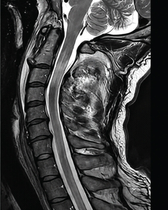 Figure2: Initial post-traumatic cervical spine magnetic resonance imaging. Sagittal view show faint, diffuse spinal cord edema, and disruption of the anterior longitudinal ligament at C2-C3.