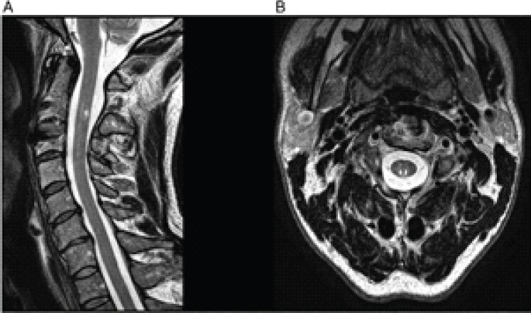 Figure 3: Follow-up cervical spine magnetic resonance imaging obtained at 1 year. Sagittal (a) and axial C3-level (b) images clearly demonstrate a spinal cord injury confined to the posterior columns, anatomically confirming posterior cord syndrome.