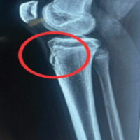 Figure 1: Lateral view of the right side (affected) X-ray showing fragmentation formation at the patellar tendon insertion (red circle).