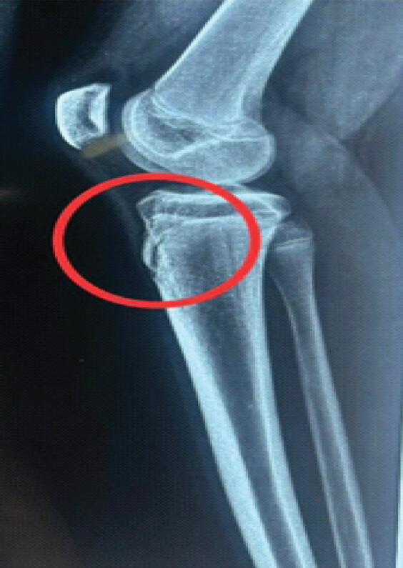 Figure 1: Lateral view of the right side (affected) X-ray showing fragmentation formation at the patellar tendon insertion (red circle).