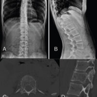 Figure 1: (a and b) Anteroposterior and lateral radiographs of the thoracolumbar spine demonstrating the D12 vertebral body with coarse trabeculations. (c and d) Pre-operative computed tomography showing corduroy and polka dot appearances in the Sagittal and Axial sections of the D12 vertebra, respectively.