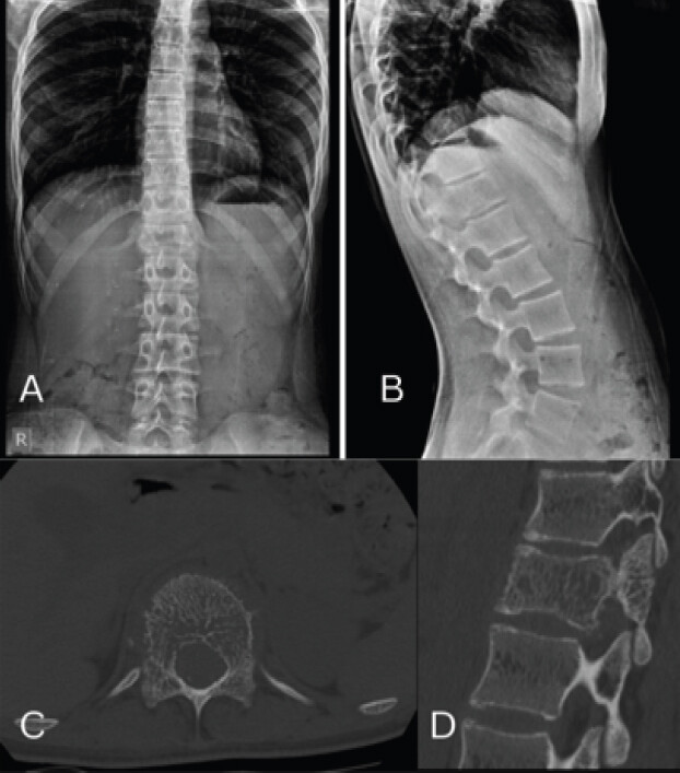 Figure 1: (a and b) Anteroposterior and lateral radiographs of the thoracolumbar spine demonstrating the D12 vertebral body with coarse trabeculations. (c and d) Pre-operative computed tomography showing corduroy and polka dot appearances in the Sagittal and Axial sections of the D12 vertebra, respectively.