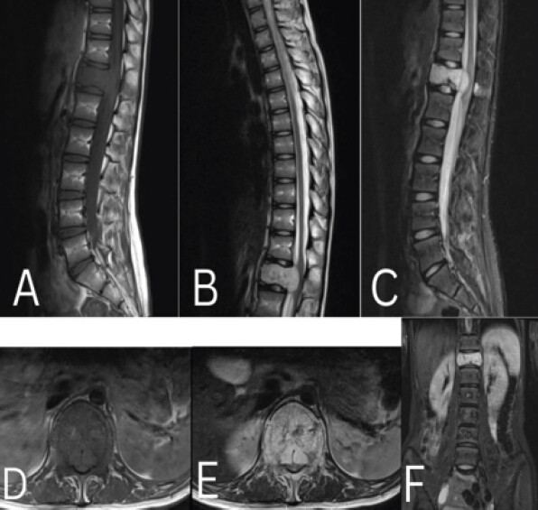 Figure 2: (a,b,c,d,e, f) Preoperative magnetic resonance imaging demonstrating an aggressive D12 vertebral hemangioma with vertebral body involvement and epidural extension causing significant spinal cord compression.